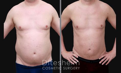Plastic Surgery For Men S Love Handles Roslyn Cosby