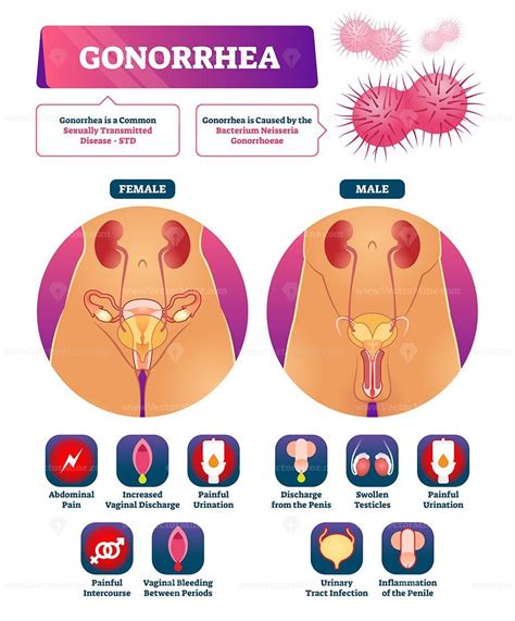 Gonorrhea Vector Illustration VectorMine Disease Infographic Std