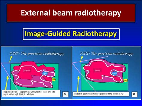 Ppt The External Beam Radiotherapy And Image Guided Radiotherapy 1