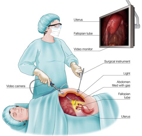 Uterus Laparoscopic Surgery