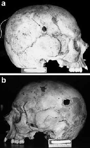 Lateral Impact On A Skull Entrance And Exit Wounds On Right A And