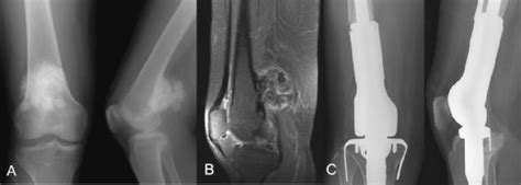 Illustrative Case Of Parosteal Osteosarcoma Treated With Marginal