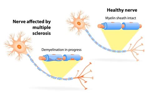 Multiple sclerosis (ms) is a relatively common acquired chronic relapsing demyelinating disease involving the central nervous system, and is the second most common cause of neurological. Esclerosis múltiple. Definición, síntomas, tratamiento y ...