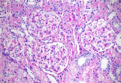 Pathology Outlines Alport Syndrome And Thin Basement Membrane Lesion
