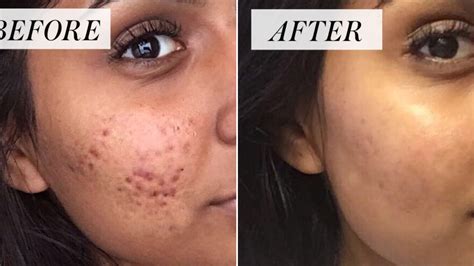 Controversial Cystic Acne Routine Goes Viral — Before And After Photos