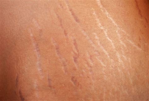 Types Of Stretch Marks