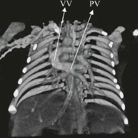 Heterotaxy Syndrome Complex Heart With Supracardiac Total Anomalous