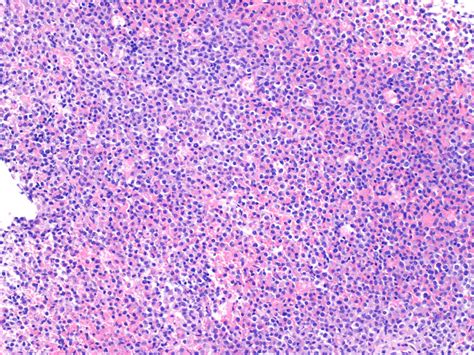 Acute Promyelocytic Leukemia Presenting As Recurrent Spinal Myeloid