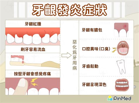 牙齦發炎怎麼辦？仍要繼續刷牙！消除牙齦炎大作戰 Pinmed