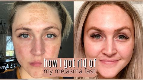 Musely Spot Cream How I Got Rid Of My Melasma Fast With Musely