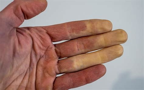 Fingers Turn Blue Or White When Cold It Could Be Raynauds University Hospitals