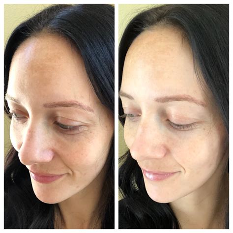 But after the declutter, this space was clear and we were able to see the vision we really had for how this space could serve our family, particularly our kids. Glyton Chemical Peel Before and After | Beauty | Outfits ...
