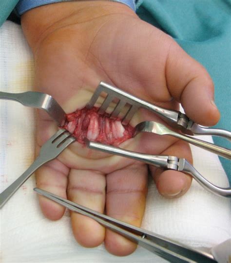 Surgical Procedure On The Left Hand Transverse Incision In The Palm