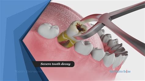 Bridges can last quite a while and also have a natural look and feel. Several Reasons Why You May Need A Tooth Extraction - YEG ...
