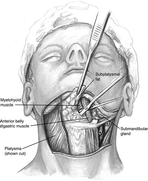 Liposuction Of The Face And Neck Operative Techniques In