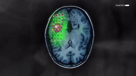 Existen casos registrados de personas diagnosticadas con muerte cerebral que reaccionan justo antes de ser intervenidas para donar sus órganos. Médicos españoles consiguen operar tumores cerebrales ...