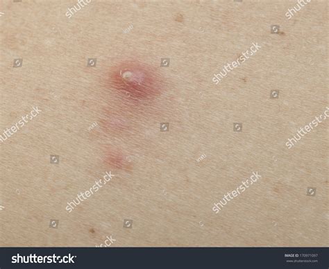 Pimple Extreme On Human Skin Macro Stock Photo 170971097 Shutterstock