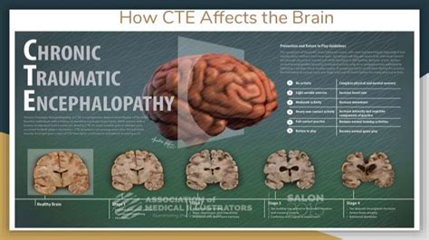 Cte Scientists Identify Brain Inflammation And Cte Connection