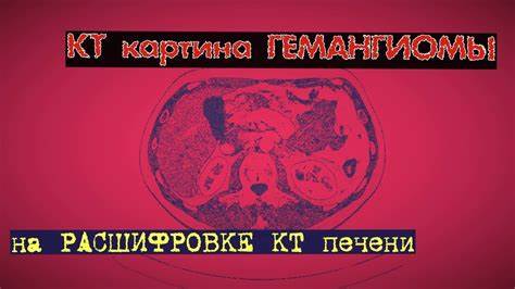 Гемангиомы печени диета КТ признаки ГЕМАНГИОМЫ печени на КТ РАСШИФРОВКЕ брюшной полости - YouTube КТ признаки ГЕМАНГИОМЫ печени на КТ РАСШИФРОВКЕ брюшной полости - YouTube Гемангиомы печени диета
