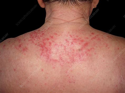 Photosensitive Eczema Stock Image C0384450 Science Photo Library