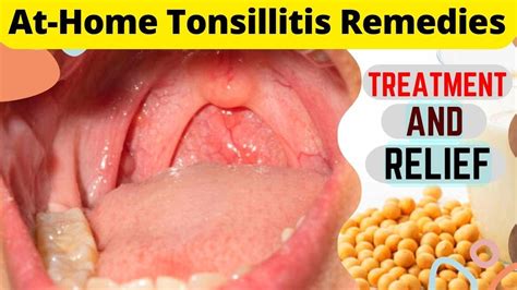 Tonsillitis Home Remedies And Cures For Fast Treatment Treat