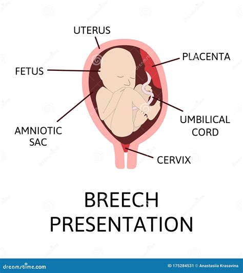 Different Baby Positions During Pregnancy Cephalic Breech Transverse