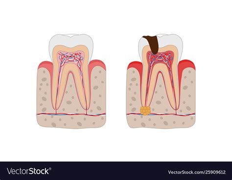 Healthy Tooth And Unhealthy Tooth With Tooth Decay