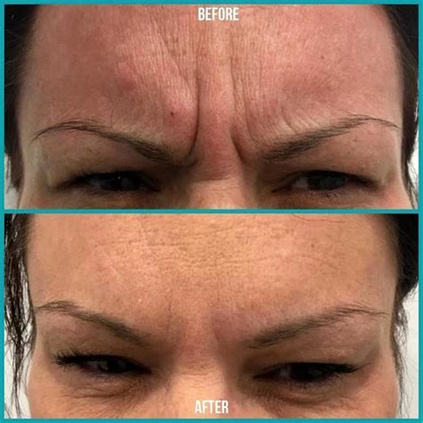 Botox 11s Before And After Photos 2 Facial Injections Info Prices