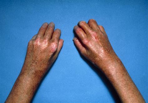 Shiny Toughened Skin On Hands Due To Scleroderma Photograph By Pixels