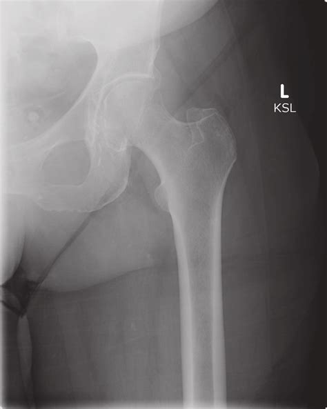 Anteroposterior Hip Radiograph Aside From Signs Of Osteoarthrosis