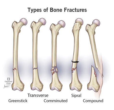 Bone fracture definition