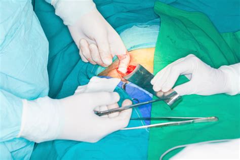 Inguinal Hernia Surgery Stock Photo Download Image Now Istock