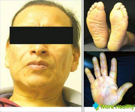 Диета при механическая желтуха Механическая желтуха. Причины и симптомы Механическая желтуха. Причины и симптомы Диета при механическая желтуха