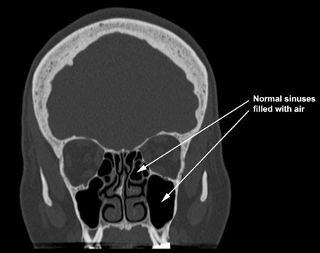 Sometimes bone is missing in the if the bone is affected, the infection may spread to the orbita. Sinusitis | Sinus Care | Henry Ford Health System ...