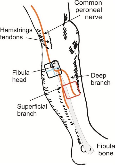 Electrode Positions Shown Relative To The Underlying Common Peroneal
