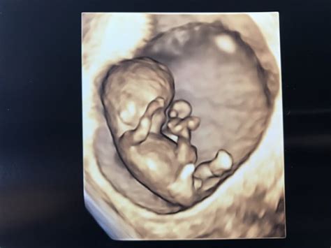 3d Ultrasound At 11 Weeks Gender Babycenter
