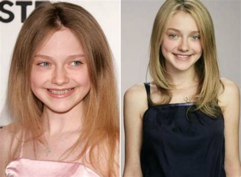 Top 10 Famous Actresses With Braces Glitzyworld