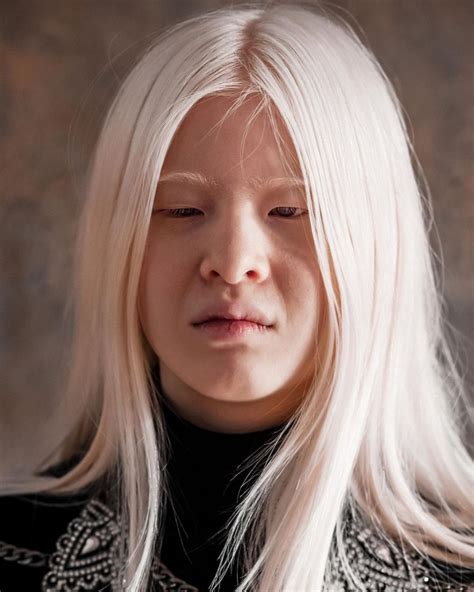 Cette jeune fille albinos a été abandonnée par ses parents à cause de son aspect physique mais