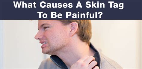 What Causes A Skin Tag To Be Painful Getting Rid Of Skin Tags