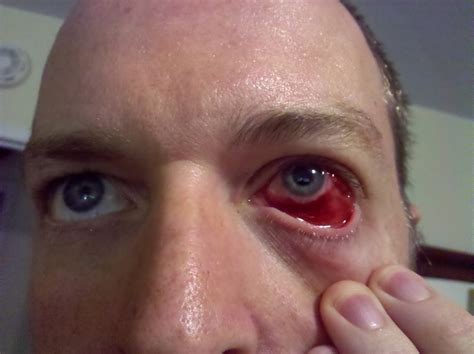 Big Trouble in Little Eyeball: A big, red eye
