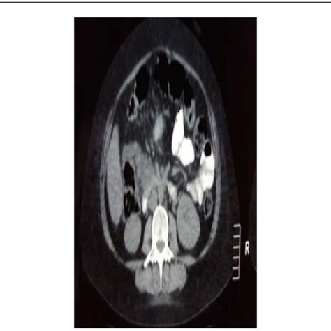 Computed Tomography Abdominal Scan With Oral And Intravenous Contrast