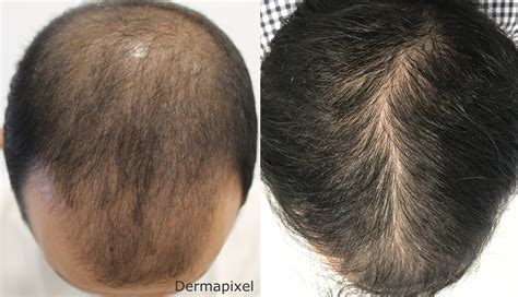 Dermapixel Alopecia Androgénica El Trasplante De Pelo No Lo Es Todo