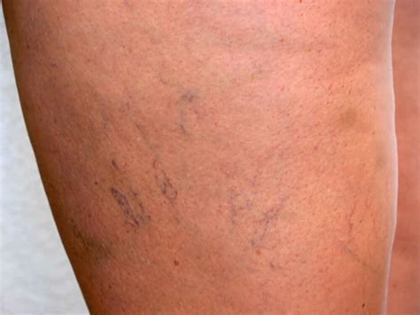 Menopause And Spider Veins Should I Be Worried