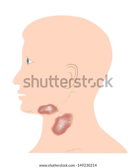 Red Swollen Lymph Nodes Lymphadentis Stock Illustration 149230214