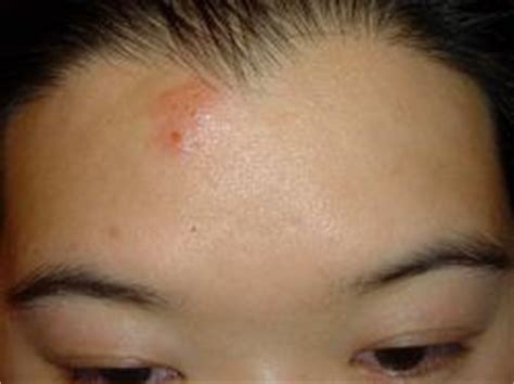 Flea bites are small red bumps that appear in clusters. jozjozjoz.com :: brain barf... yum!: And no special powers ...