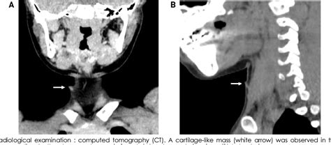 Figure 1 From Unilateral Cervical Chondrocutaneous Branchial Remnant In