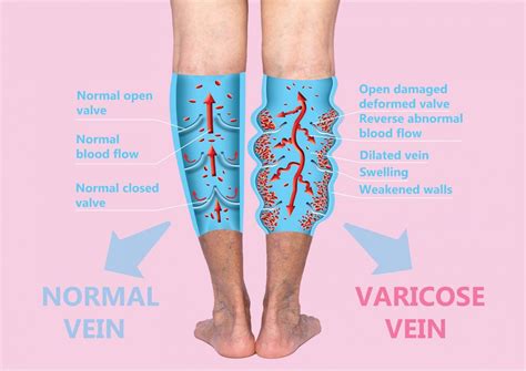 Vein Treatments Vein Specialists Of The Carolinas Treat Thousands Yearly