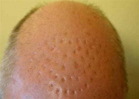 A Hair Transplant Surgery Fail 5 Pics