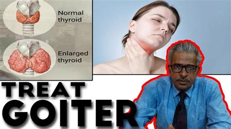Goiter Treatment In Homeopathy By Dr Ps Tiwari Youtube