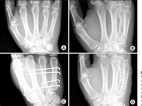 Figure 1 From Treatment Of Metacarpal Fractures Using Transverse